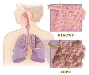 COPD v a healthy lung